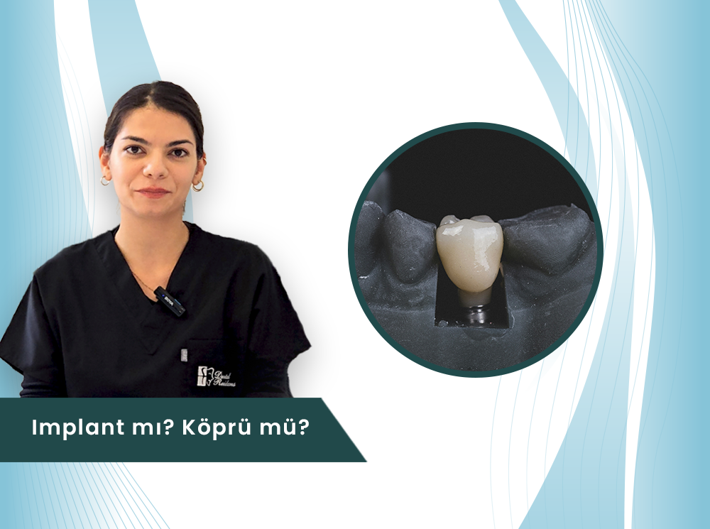 Implant mı? Köprü mü?